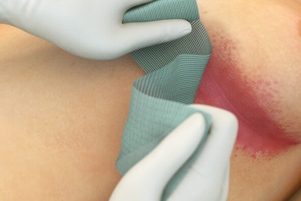 Person plasserer Sorbact Fungi-bandasje på infisert område under et bryst.