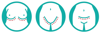 Illustrasjon som viser vanlige bruksområder for Sorbact Fungi: under brystene, i lysken og i hudfolder.